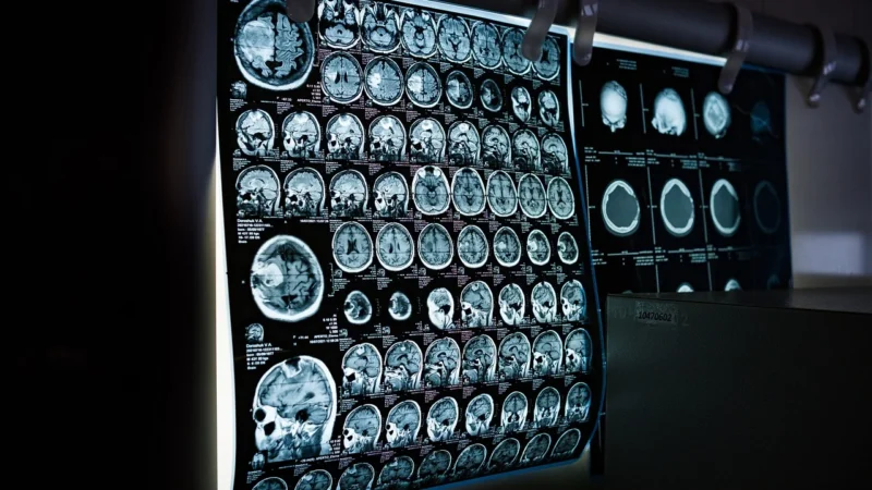 Fuzjonalna biopsja prostaty: nowoczesna metoda diagnostyki raka prostaty